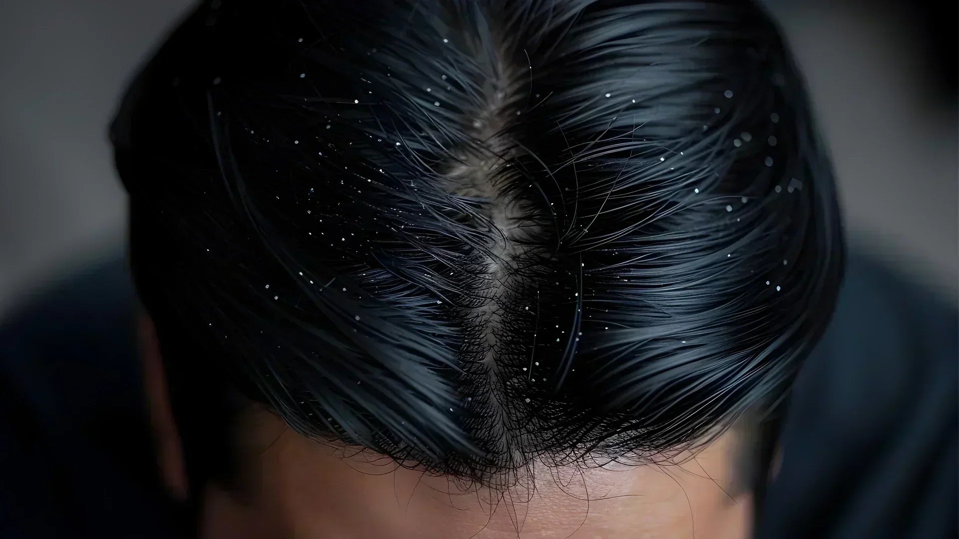 Roos schilfers haar behandeling