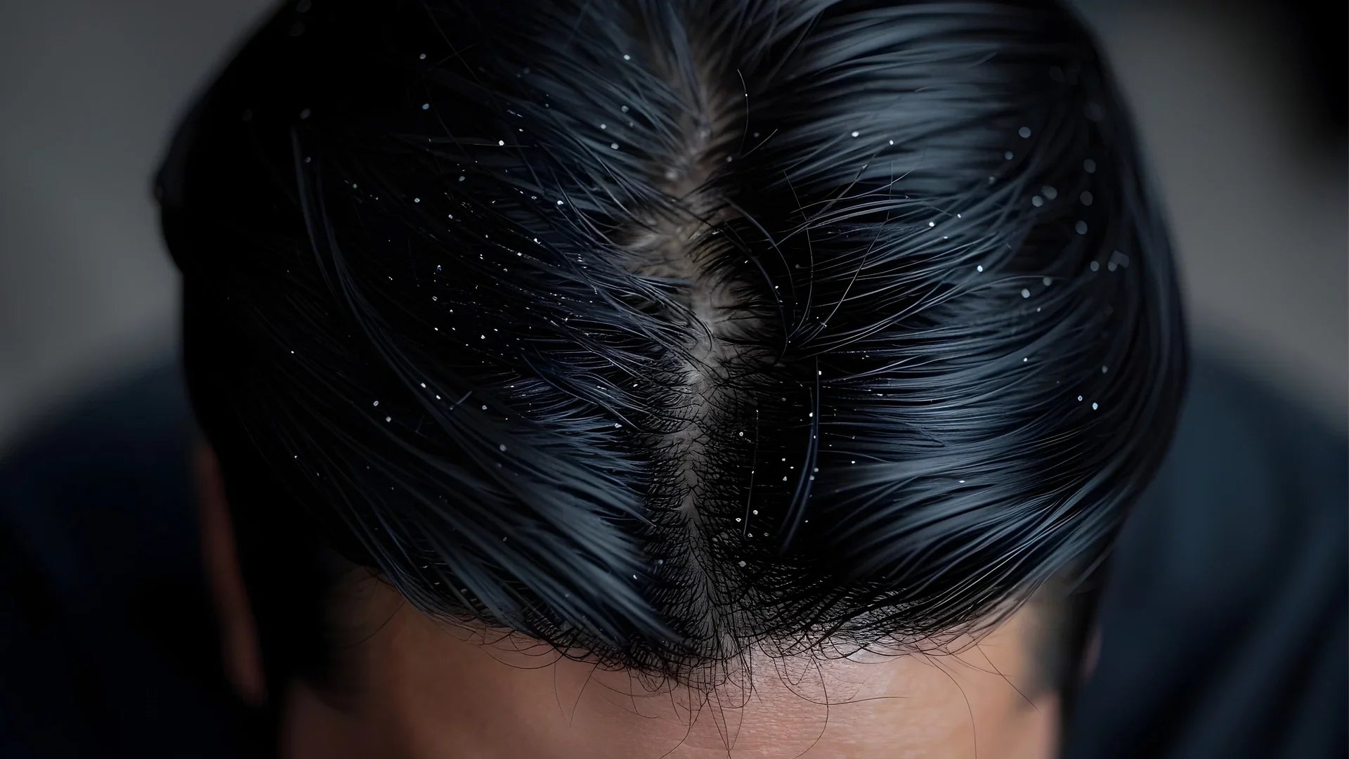 Roos schilfers haar behandeling