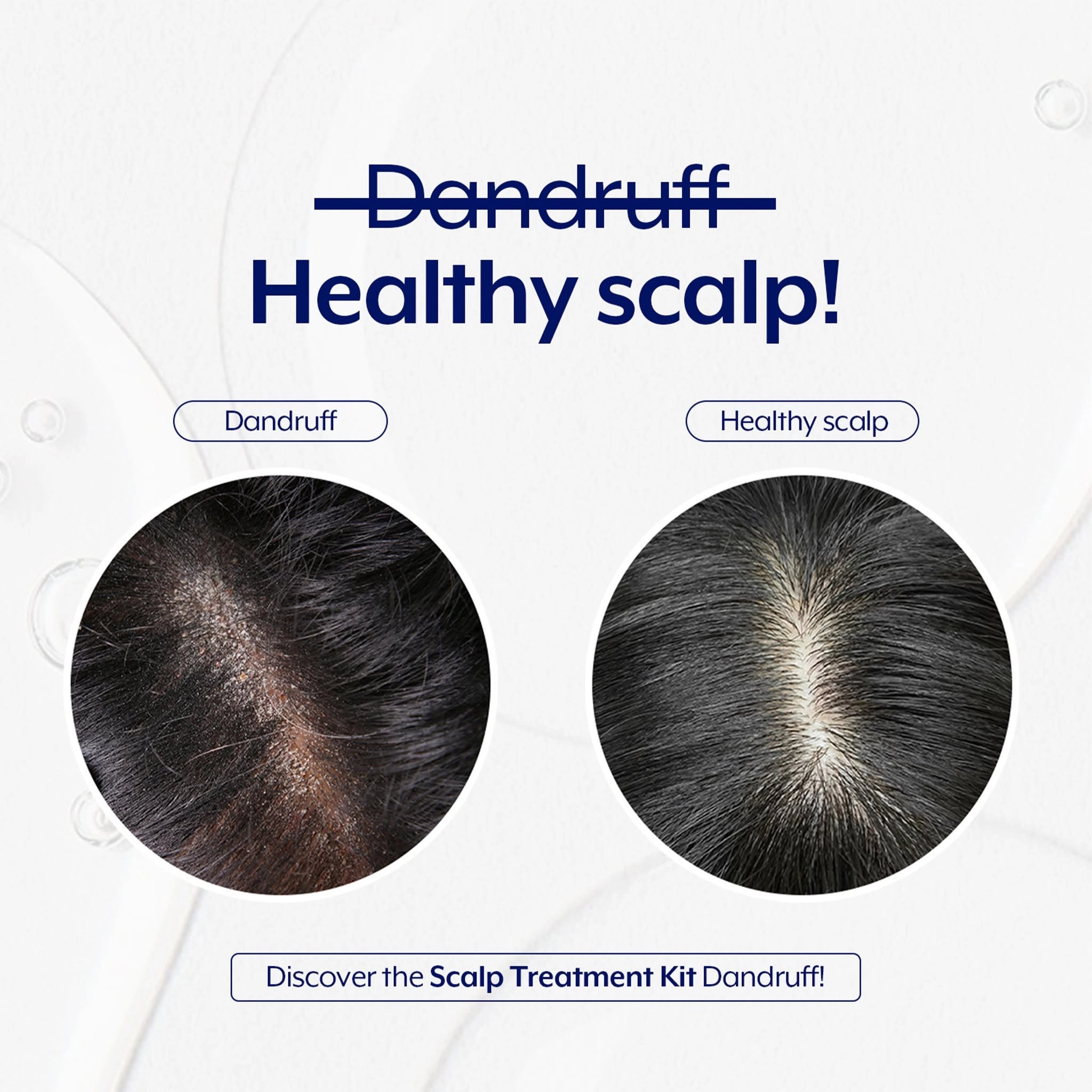 Dandruff Treatment Anti Roos Behandeling
