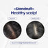 Dandruff Treatment Anti Roos Behandeling