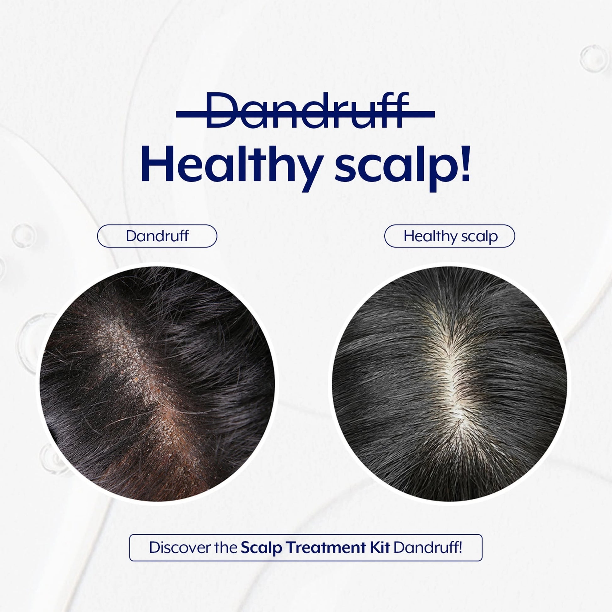 Dandruff Treatment Anti Roos Behandeling